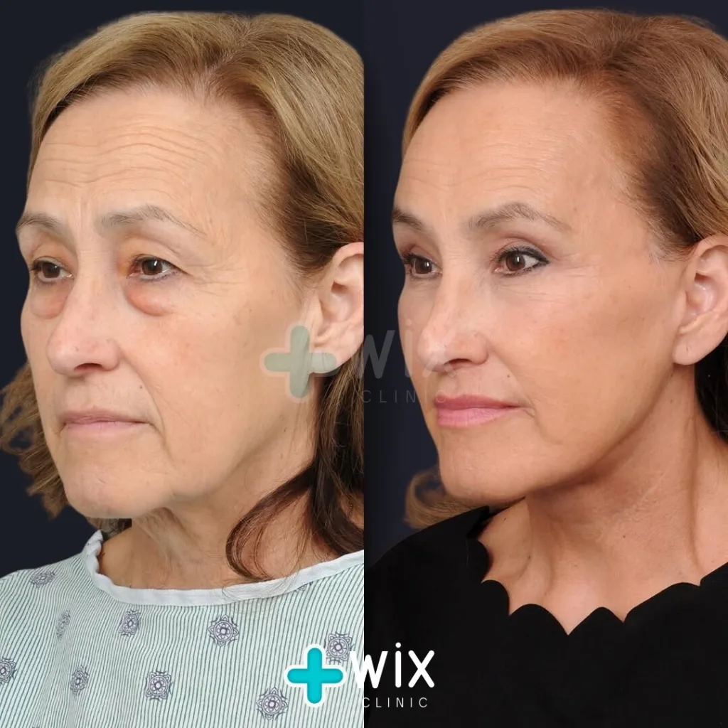 Necklift before and after