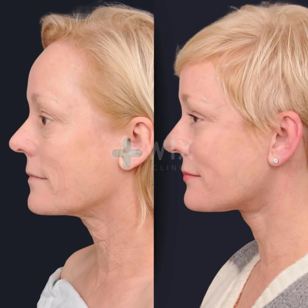 Necklift before and after