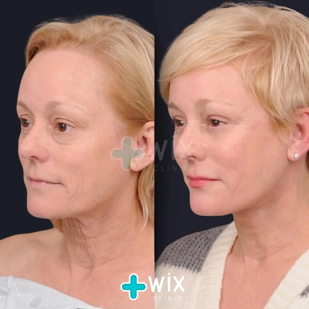 Necklift before and after