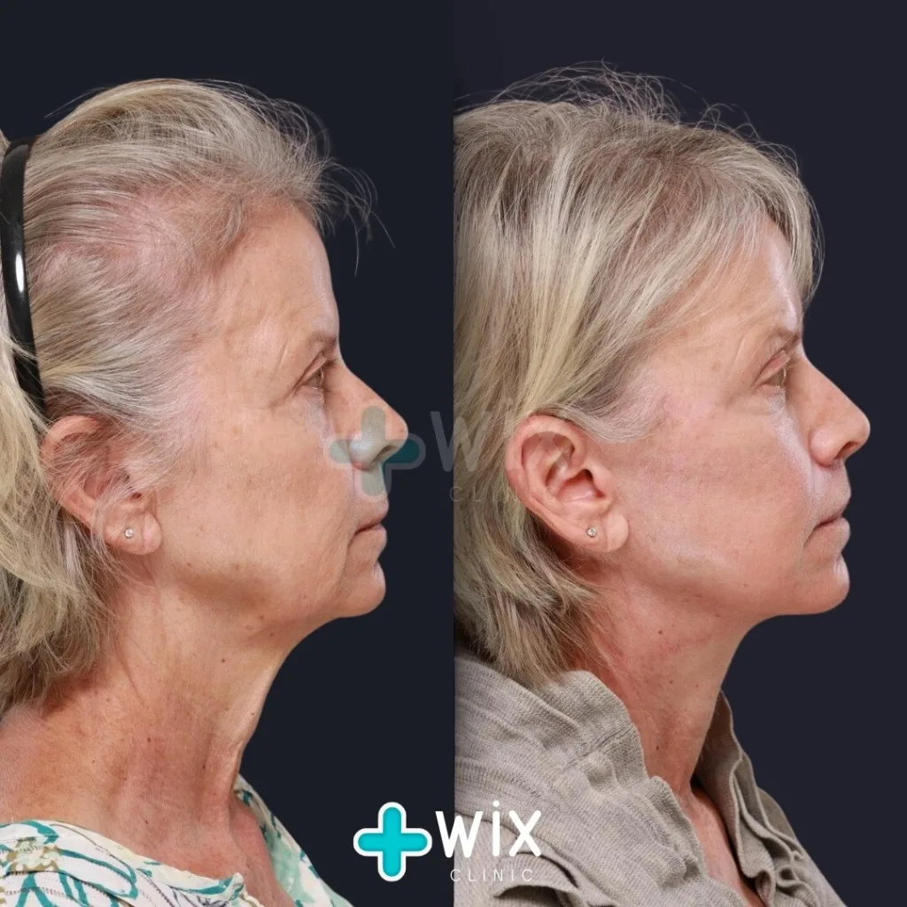 Necklift before and after