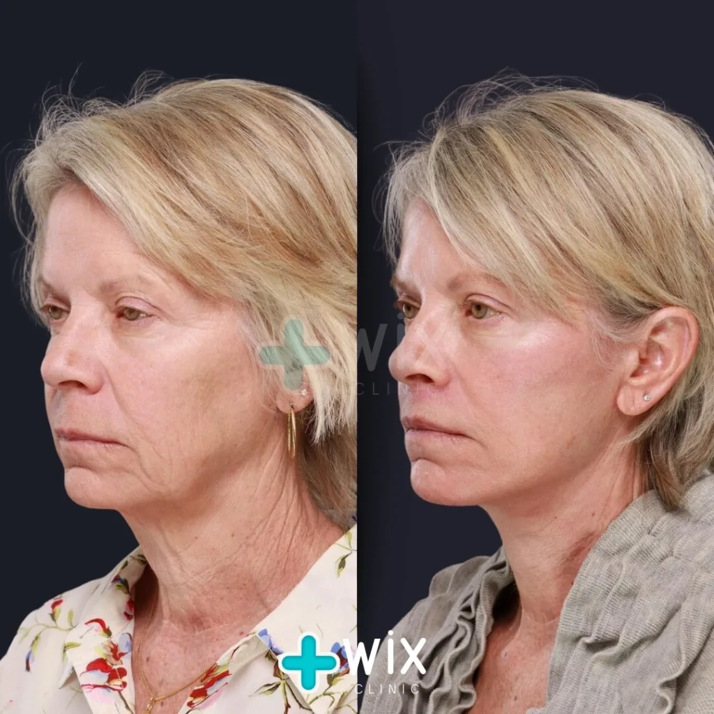 Necklift before and after