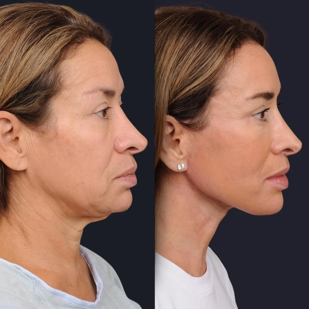 Necklift before and after