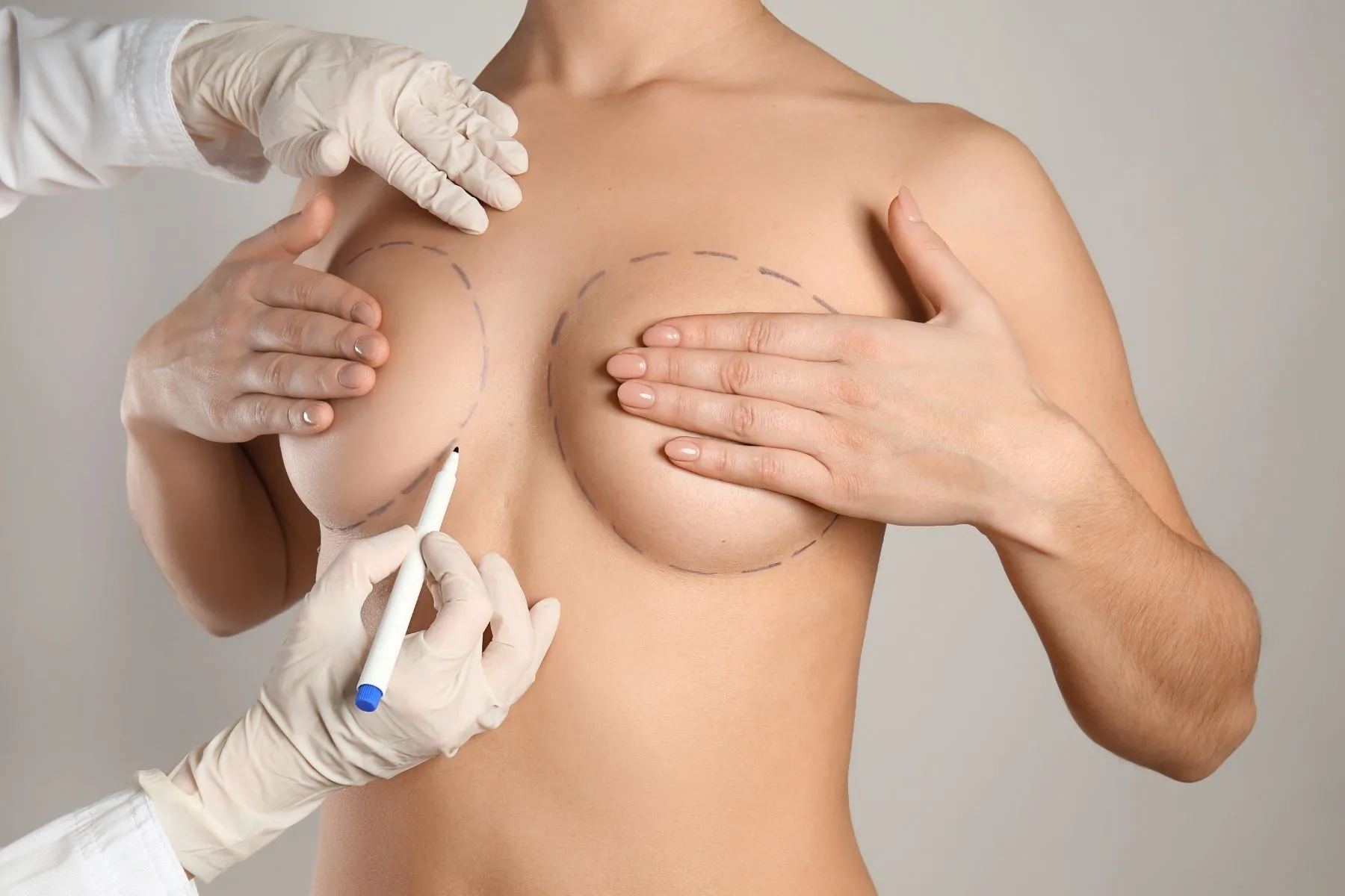 Nipple Reconstruction Surgery