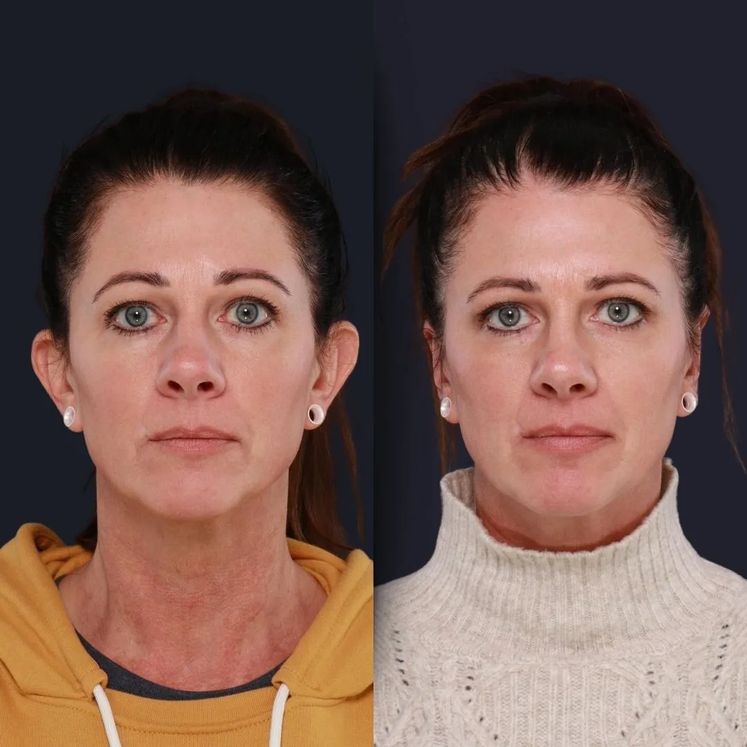 Otoplasty Before and After