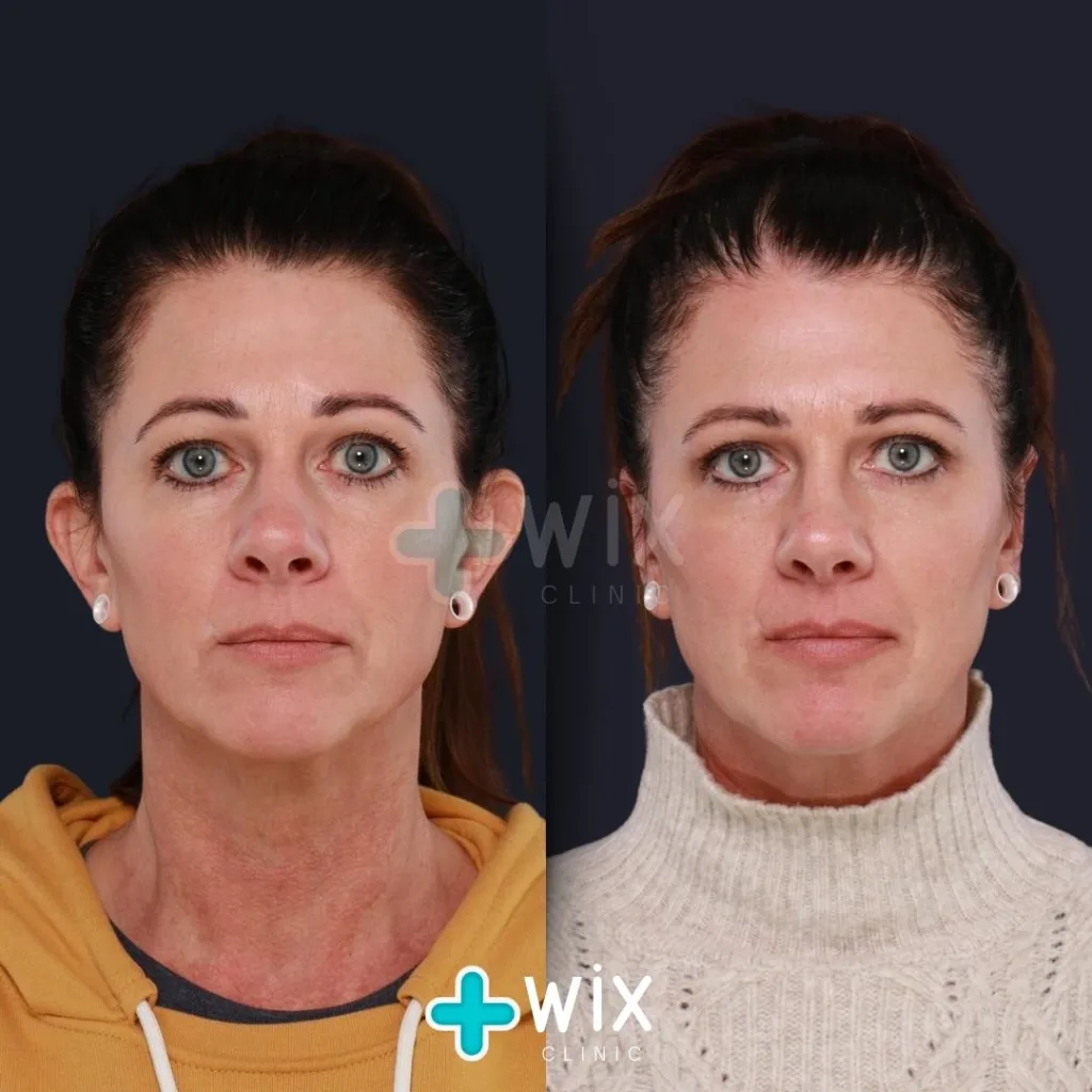 Otoplasty before and after