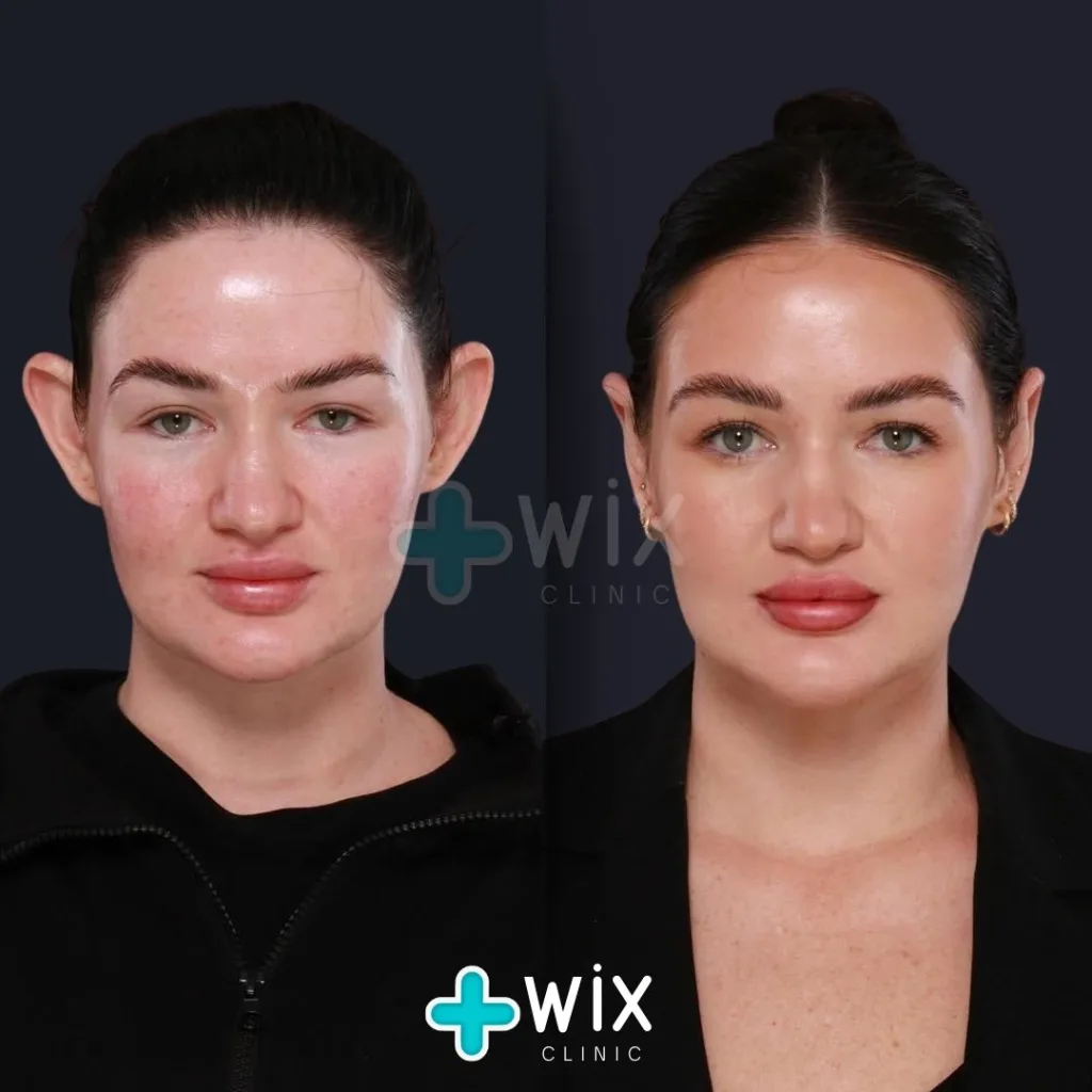 Otoplasty before and after