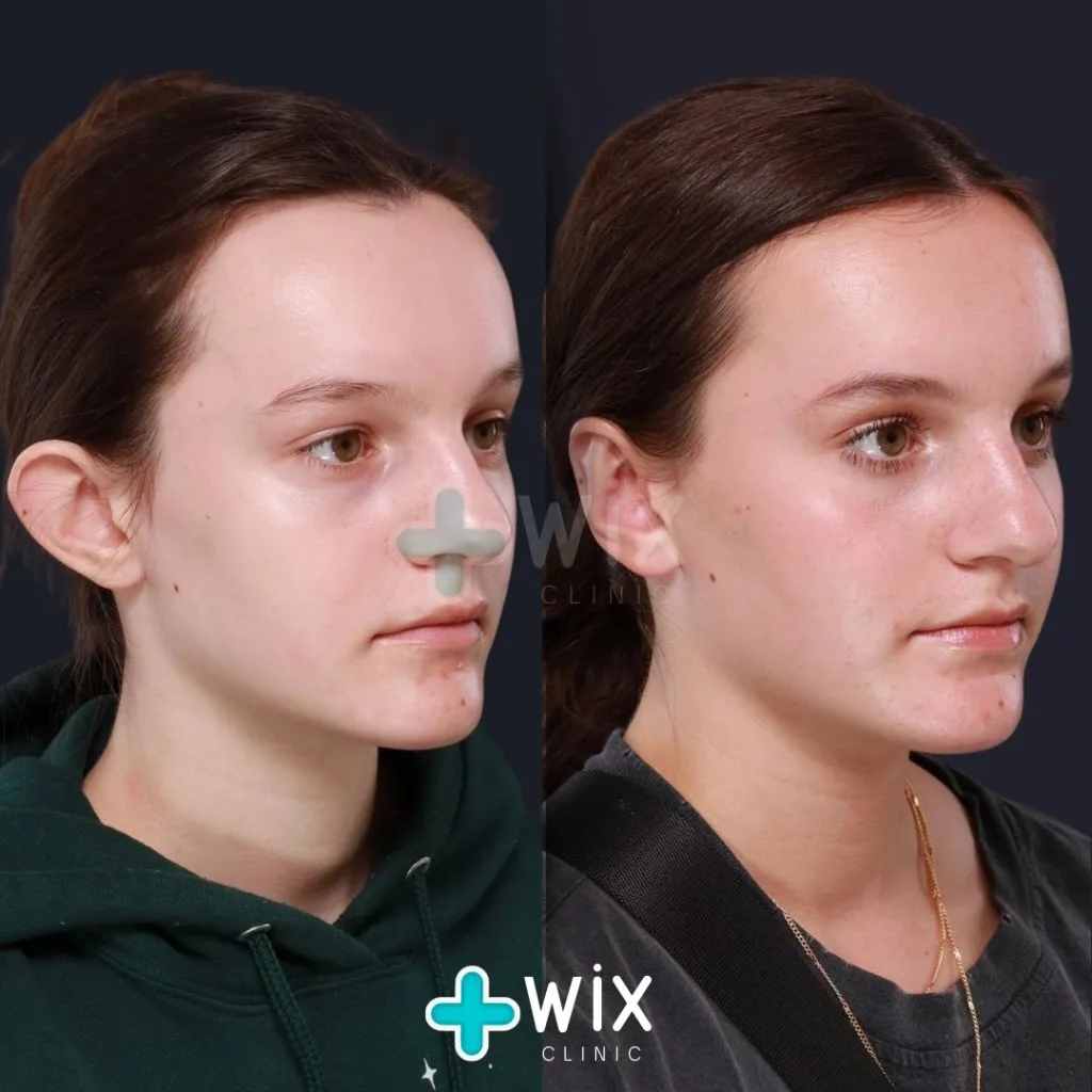 Otoplasty before and after