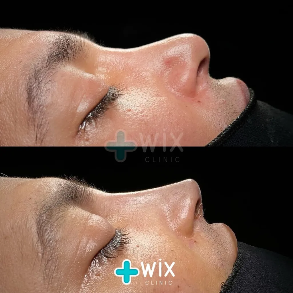 Rhinoplasty Before and After