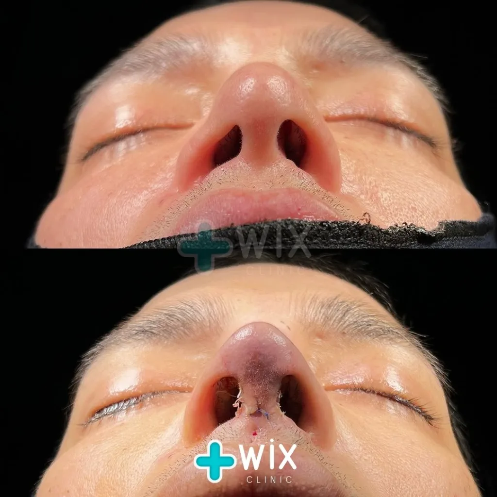 Rhinoplasty Before and After