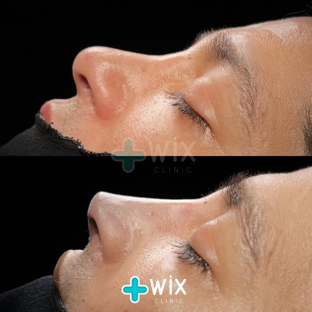 Rhinoplasty Before and After