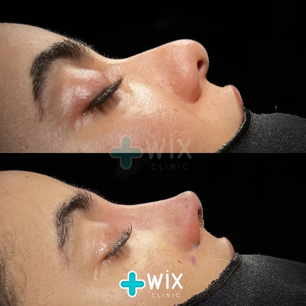 Rhinoplasty Before and After