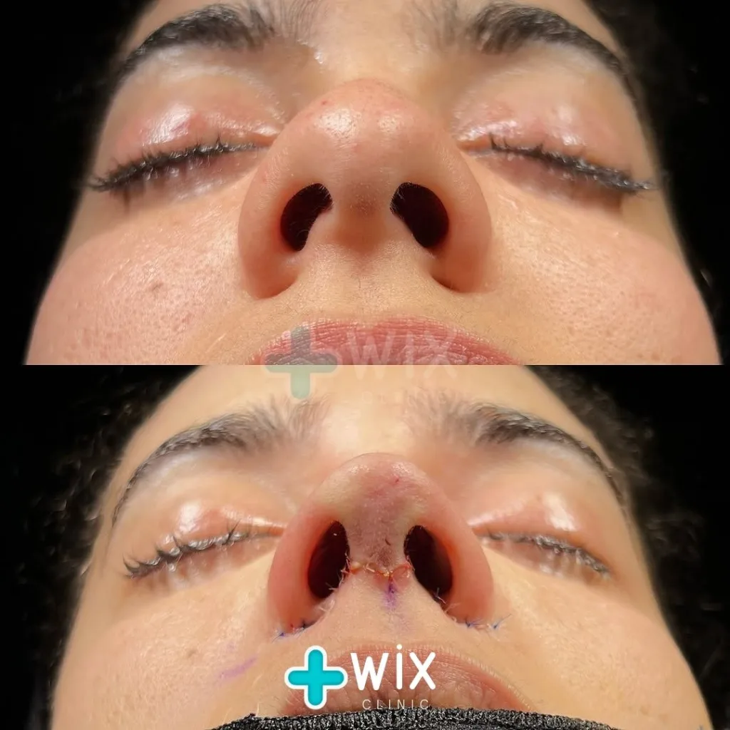 Rhinoplasty Before and After