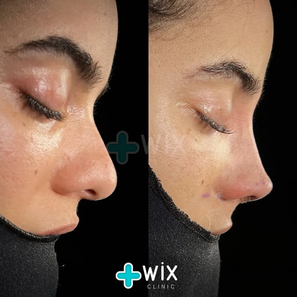 Rhinoplasty Before and After