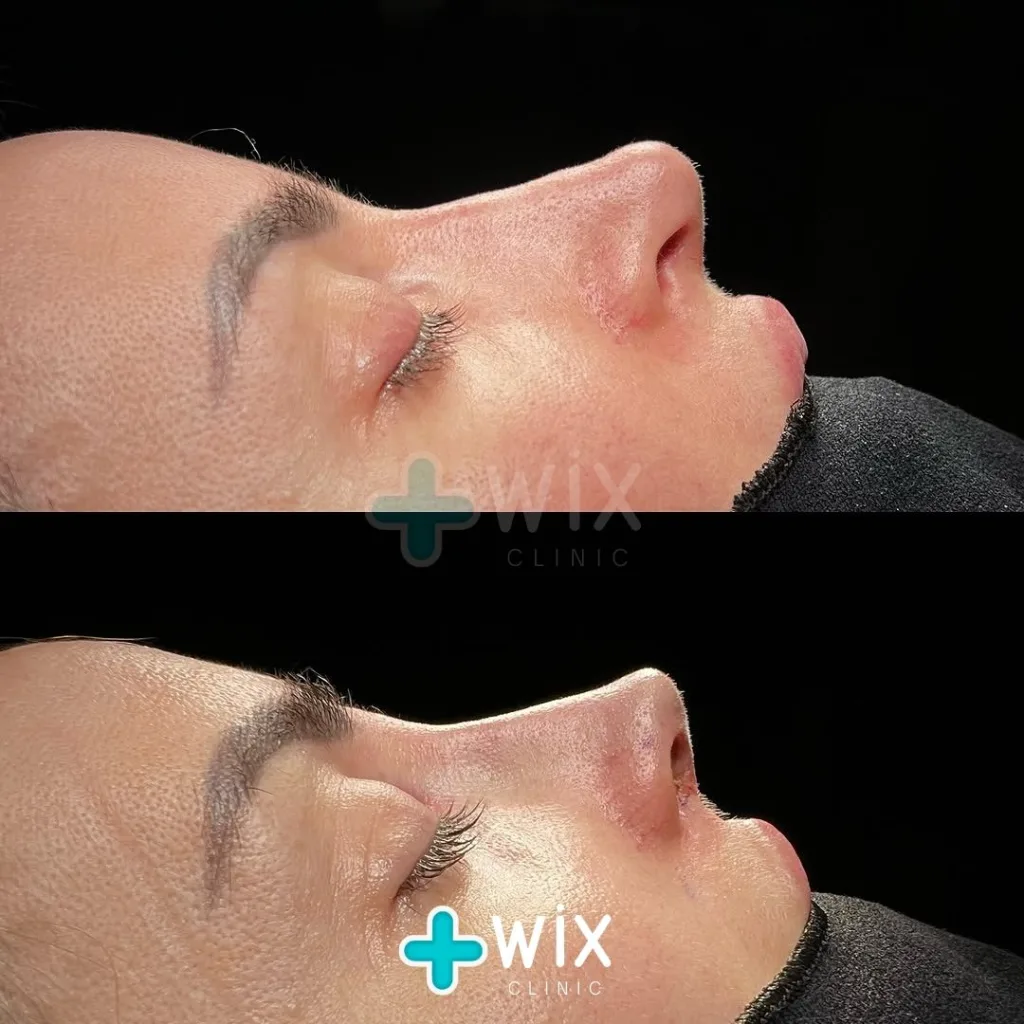 Rhinoplasty Before and After