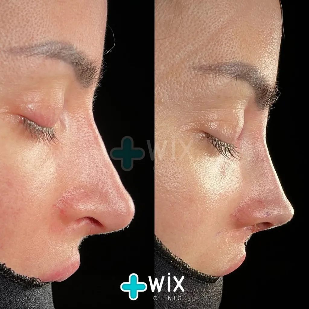 Rhinoplasty Before and After