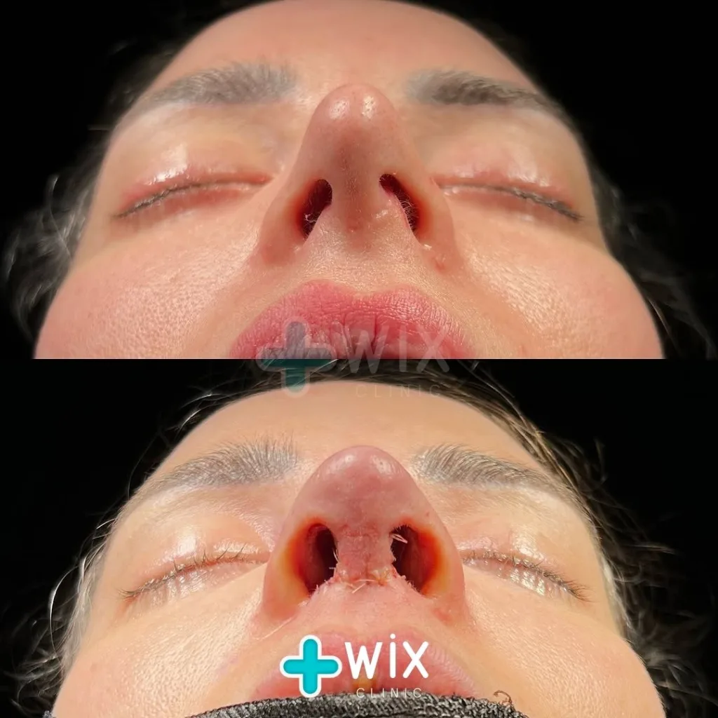 Rhinoplasty Before and After