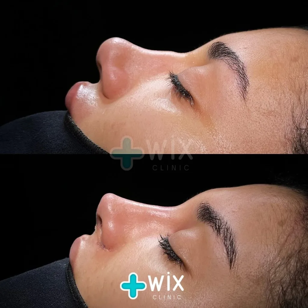 Rhinoplasty Before and After