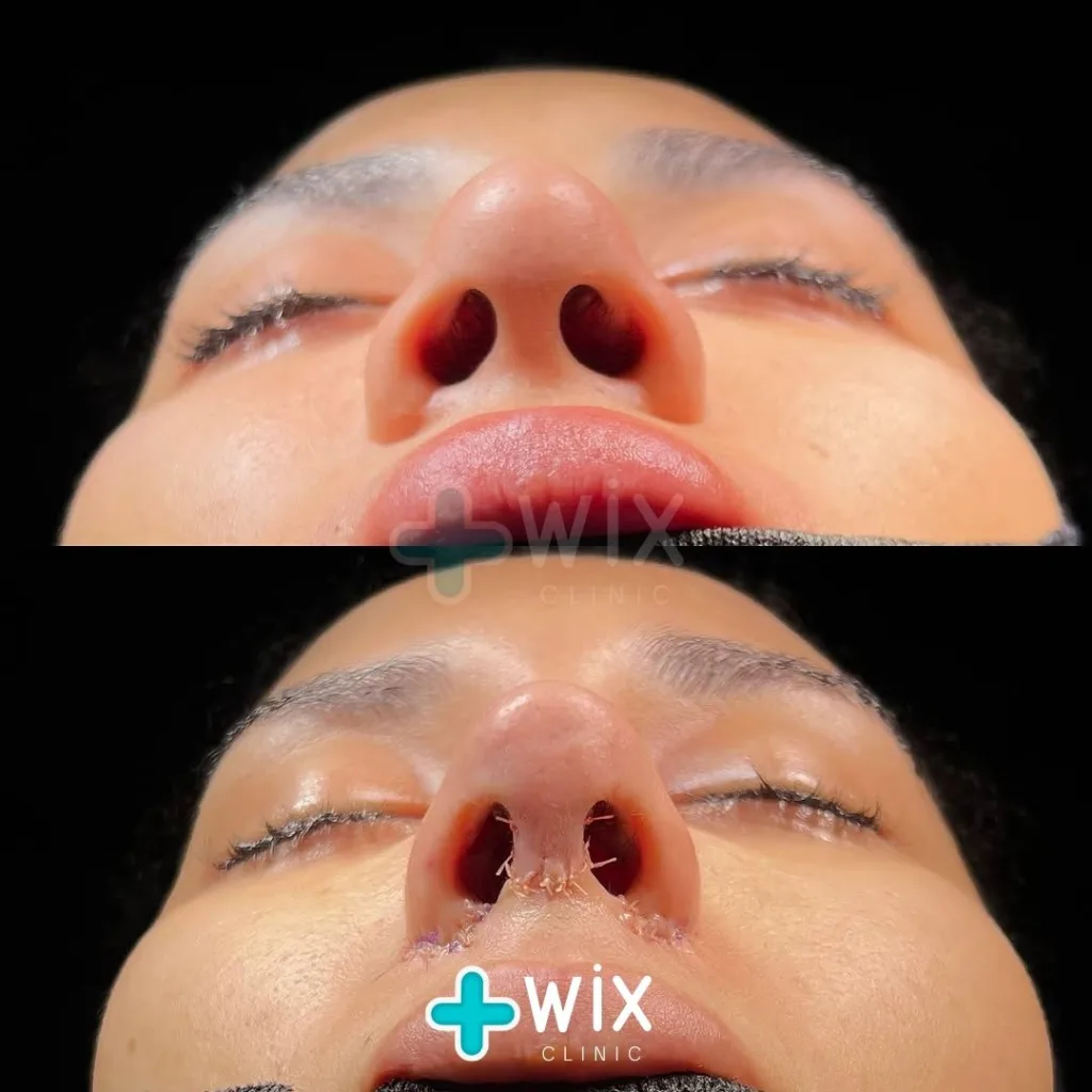 Rhinoplasty Before and After