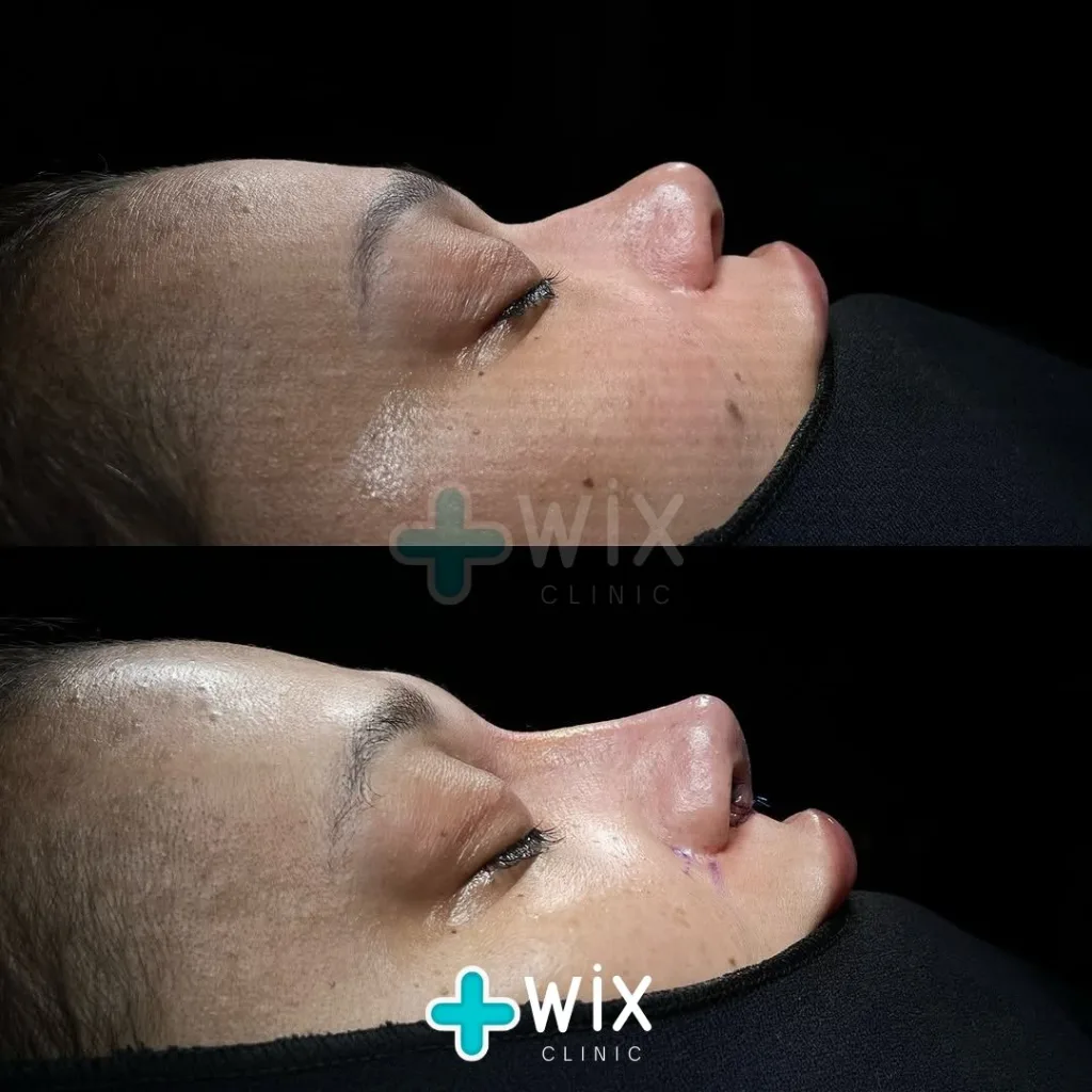 Rhinoplasty Before and After