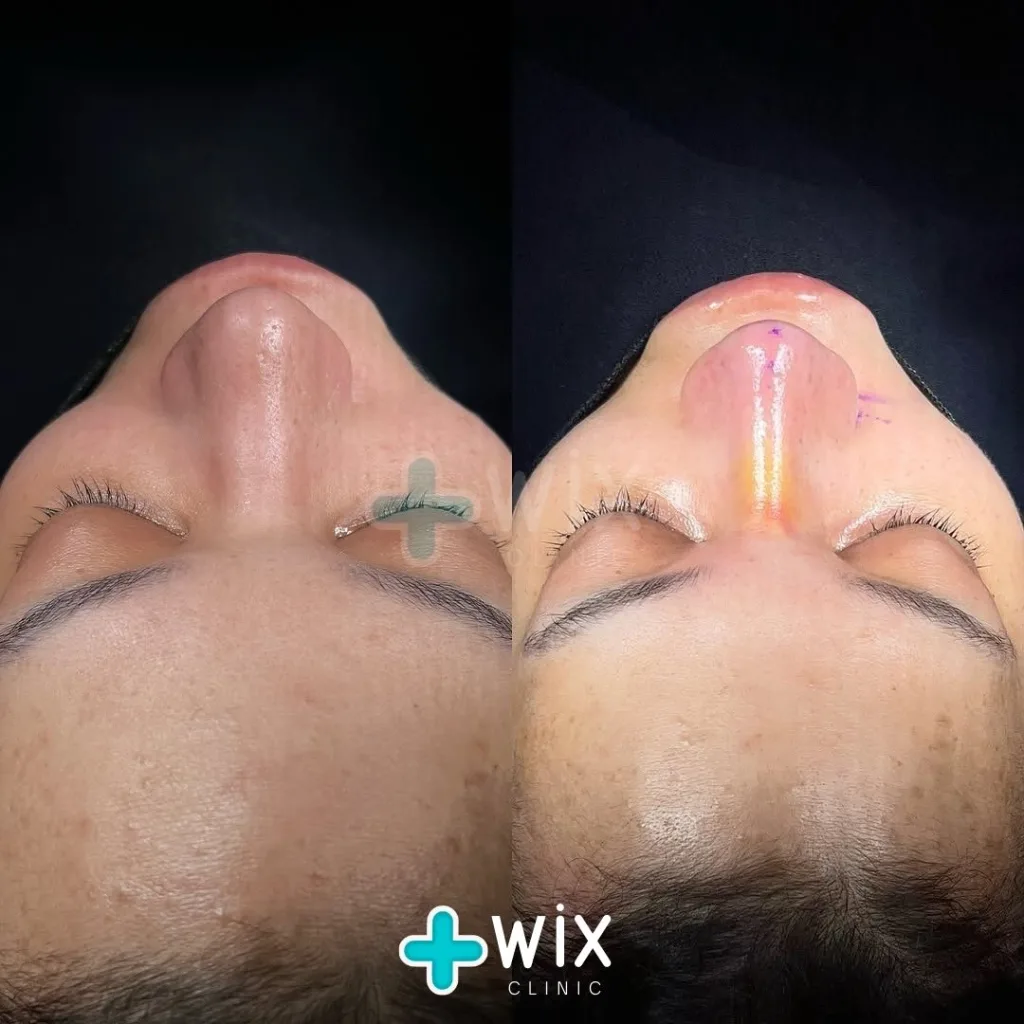 Rhinoplasty Before and After