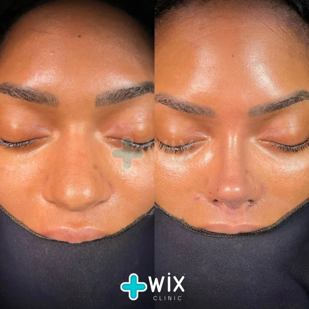 Rhinoplasty Before and After