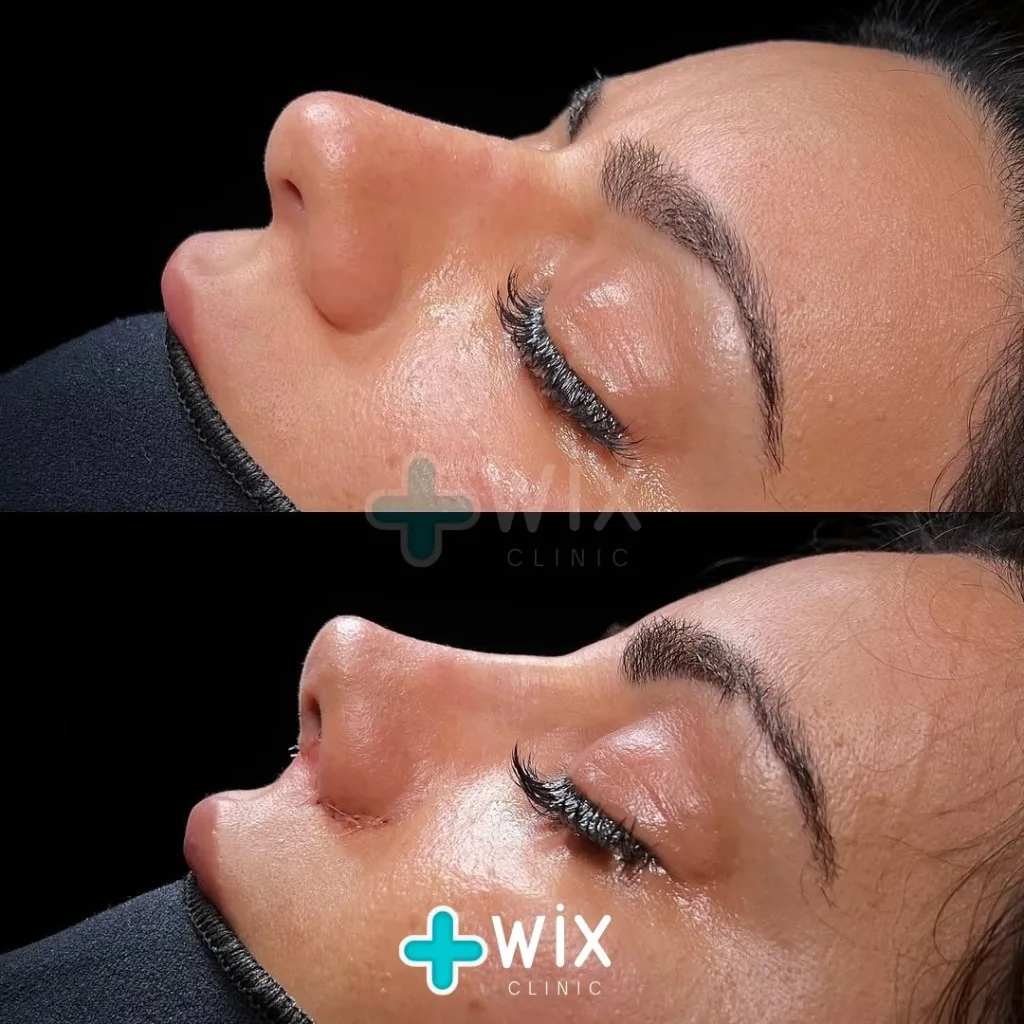 Rhinoplasty Before and After