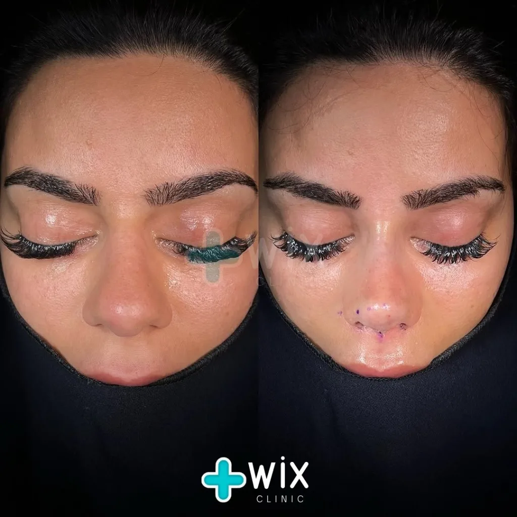 Rhinoplasty Before and After