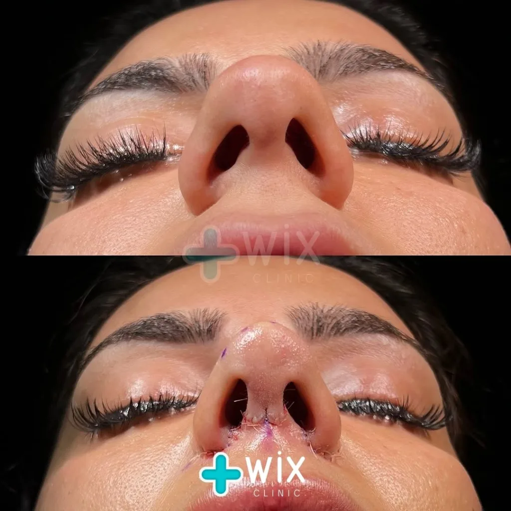 Rhinoplasty Before and After