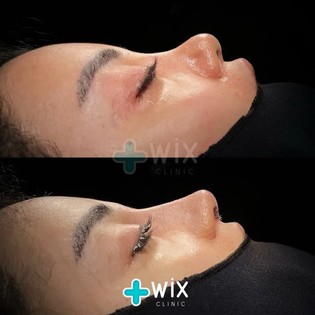 Rhinoplasty Before and After