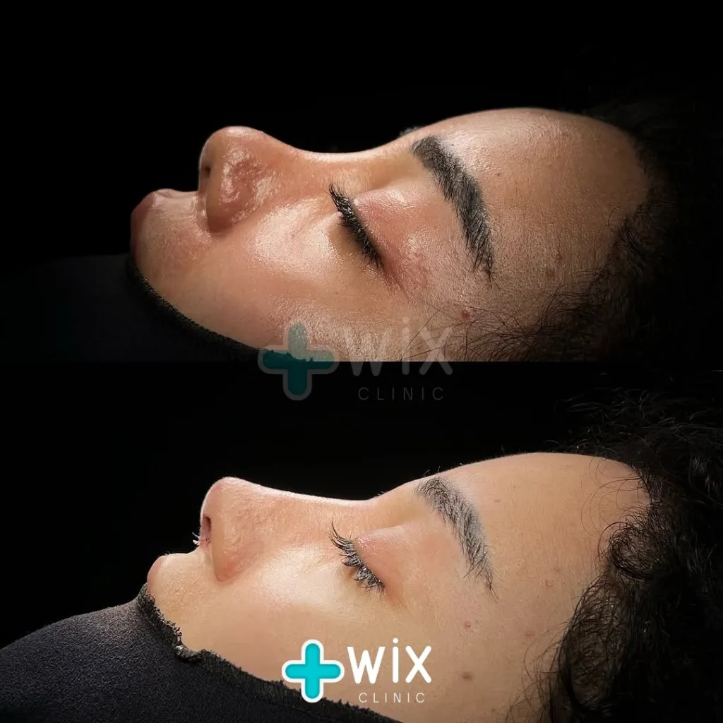 Rhinoplasty Before and After