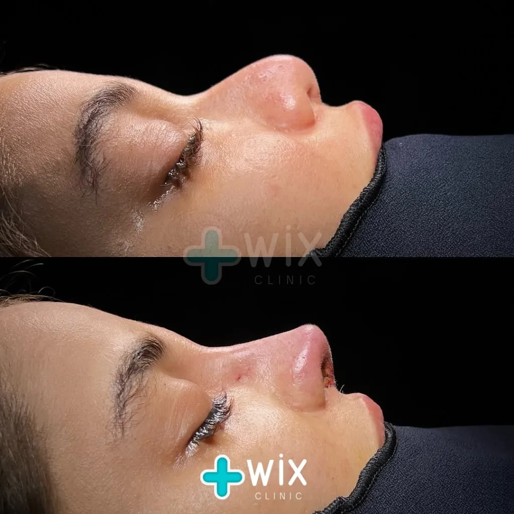 Rhinoplasty Before and After