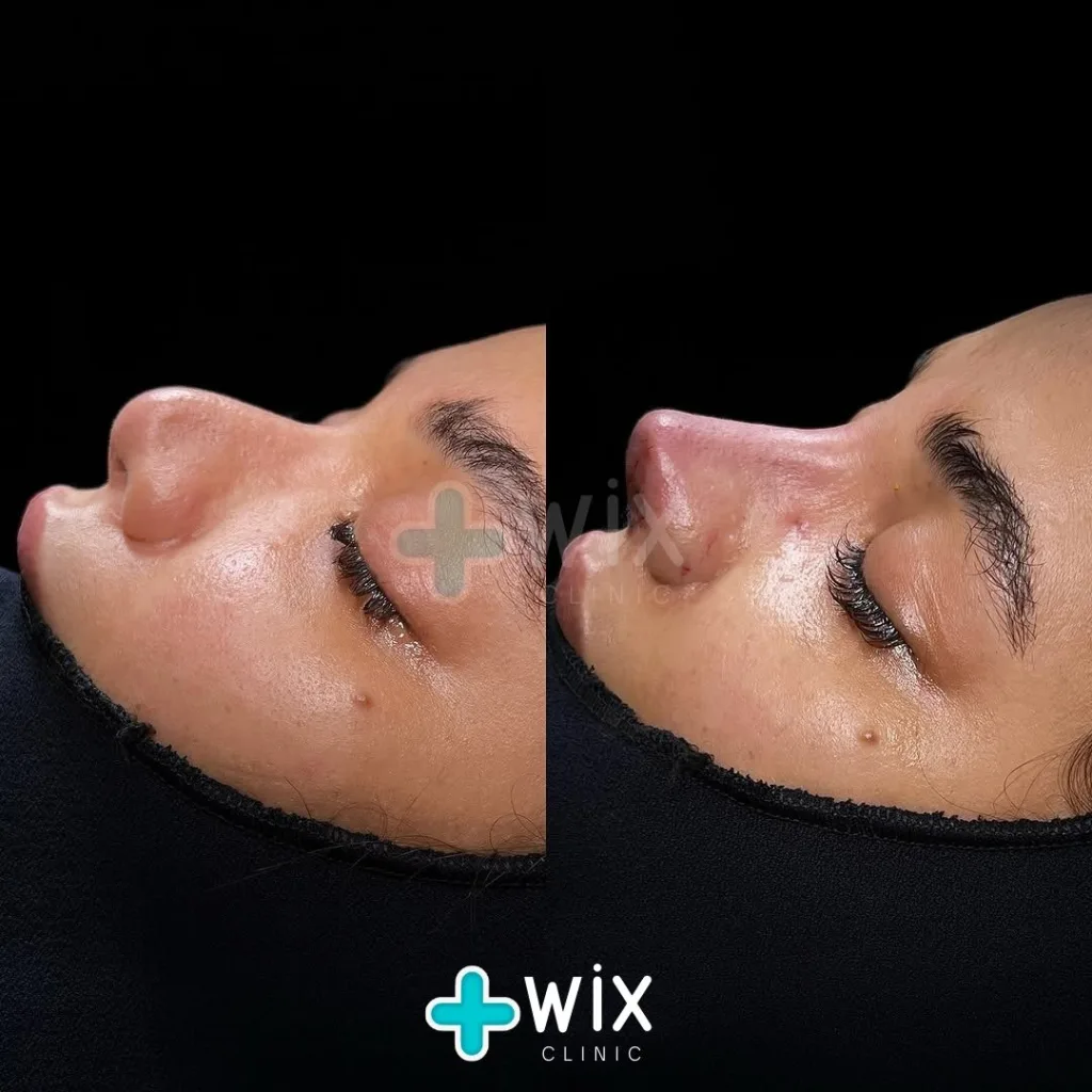 Rhinoplasty Before and After