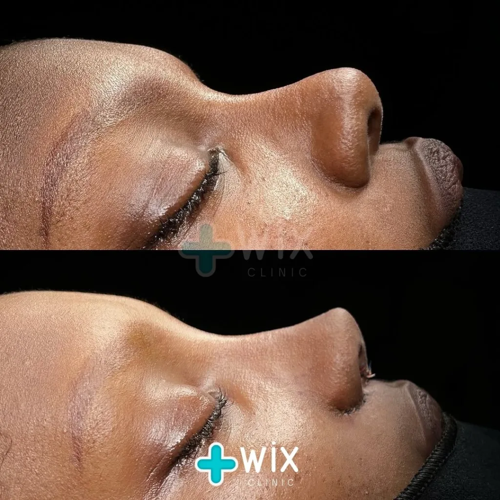 Rhinoplasty Before and After