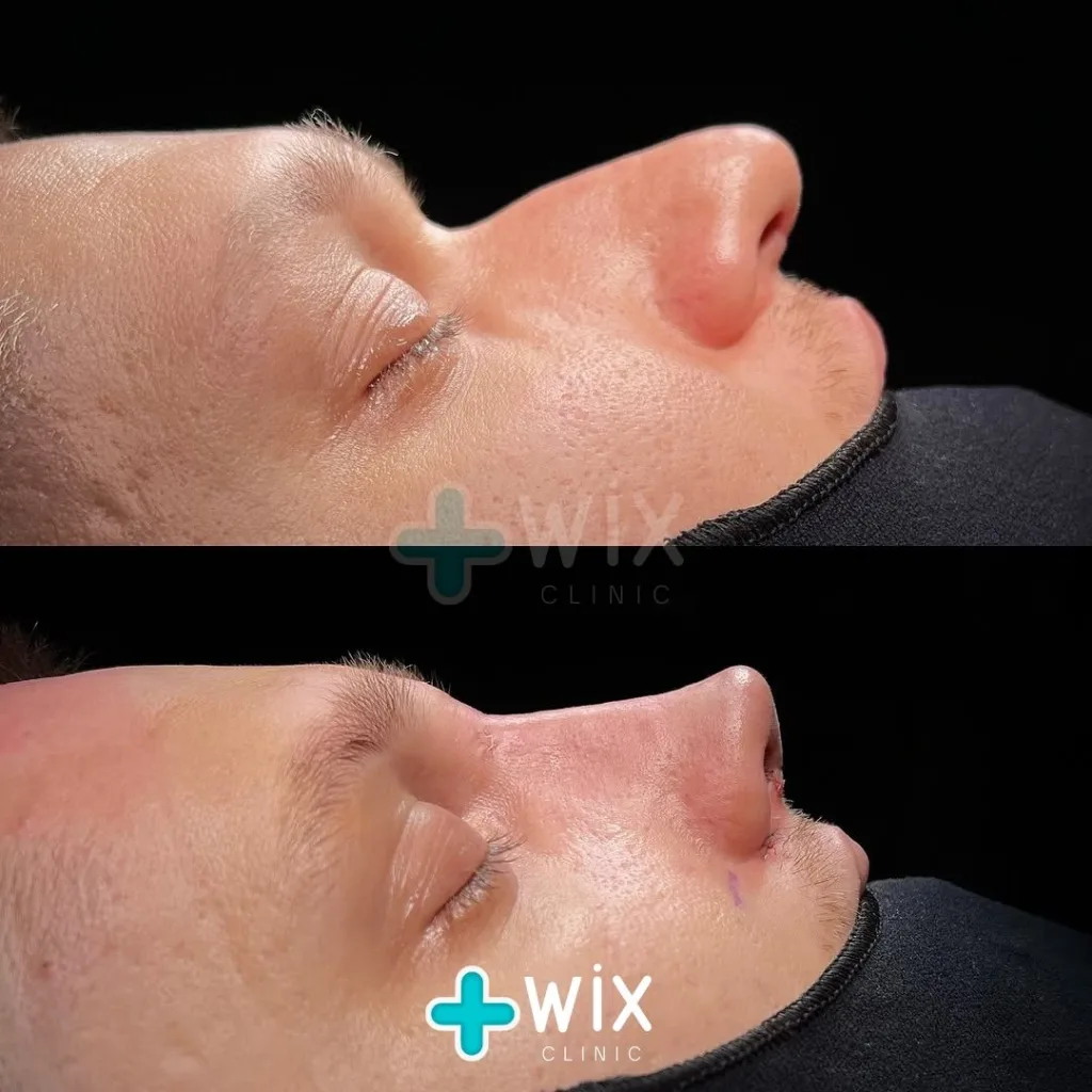 Rhinoplasty Before and After