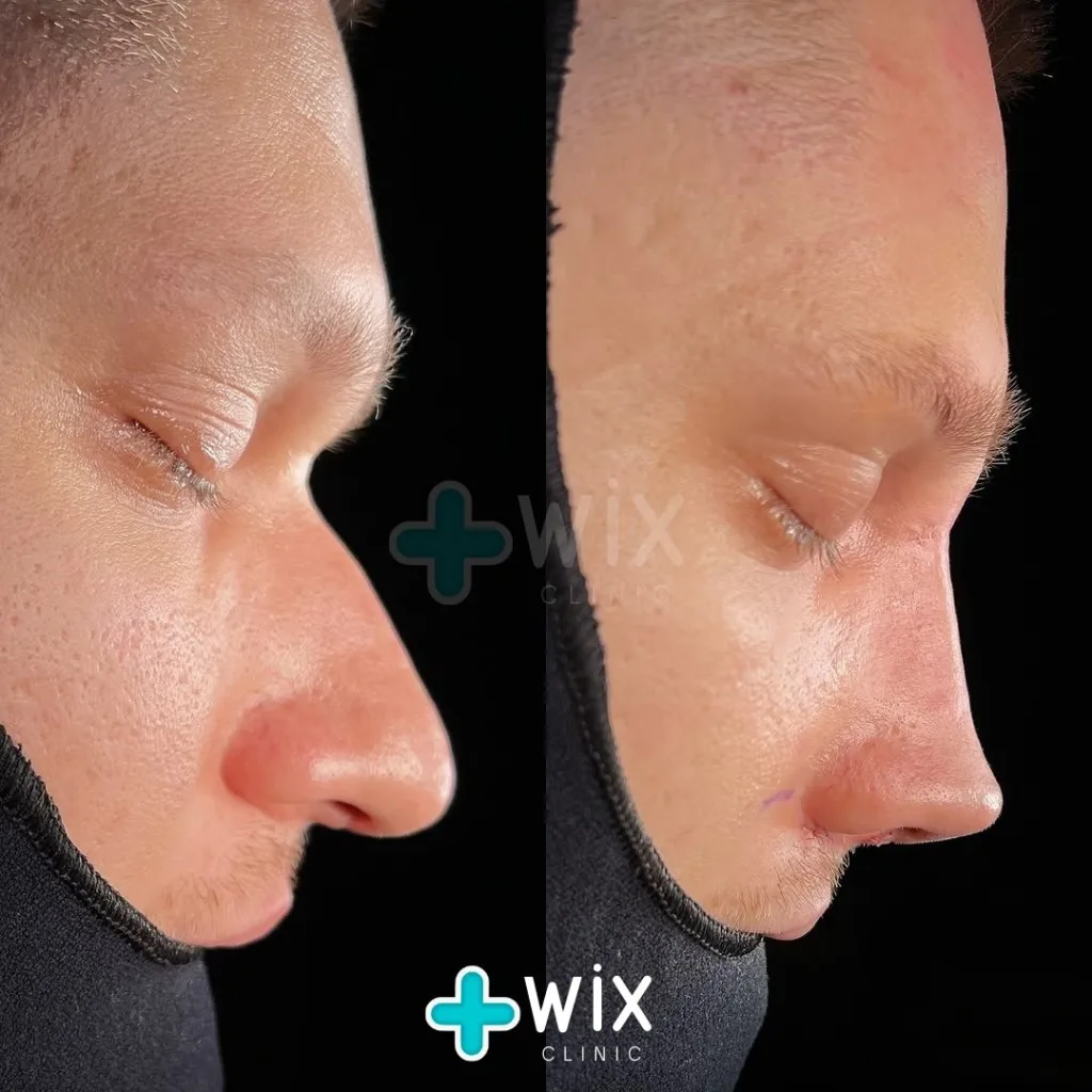 Rhinoplasty Before and After