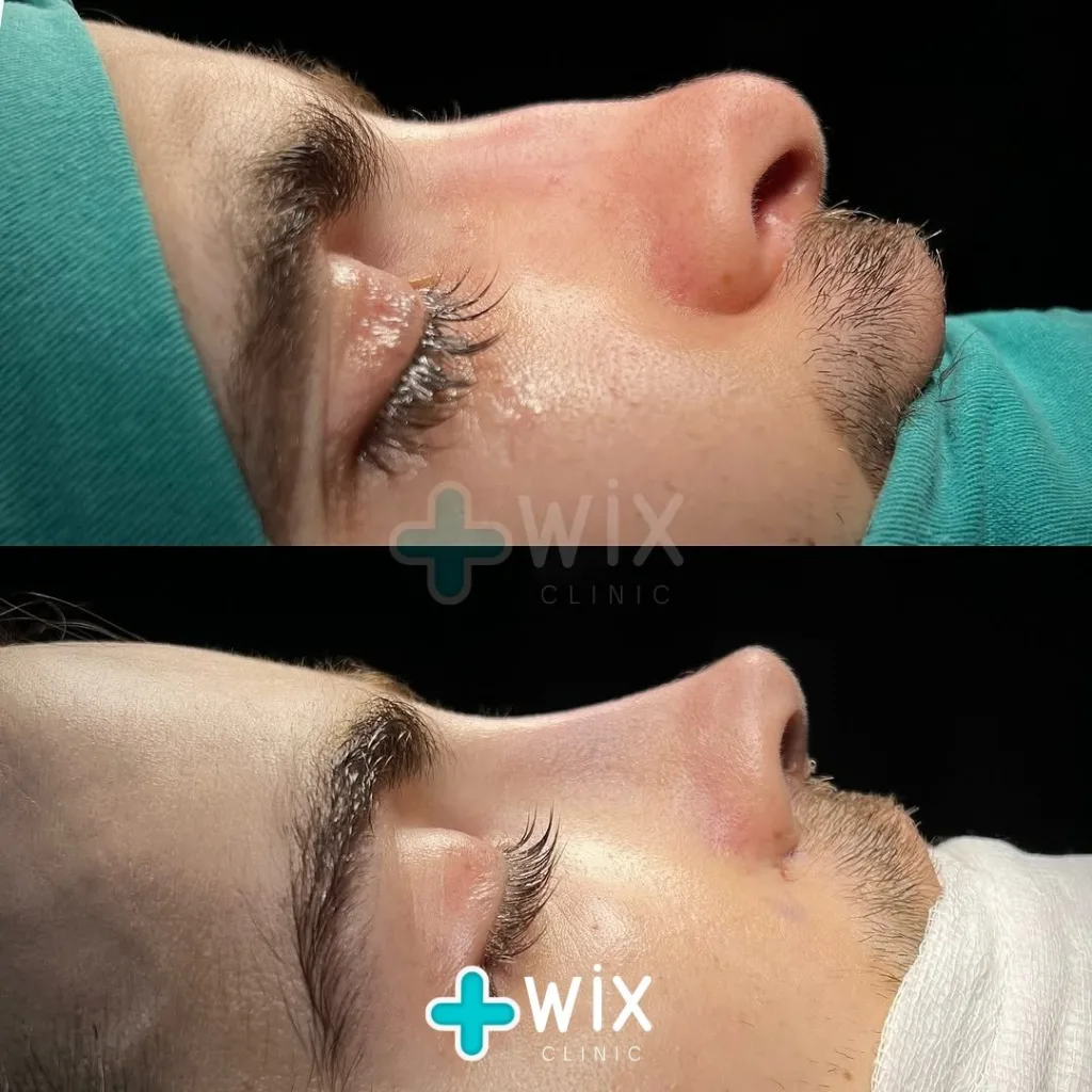 Rhinoplasty Before and After