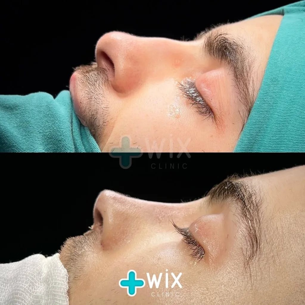 Rhinoplasty Before and After