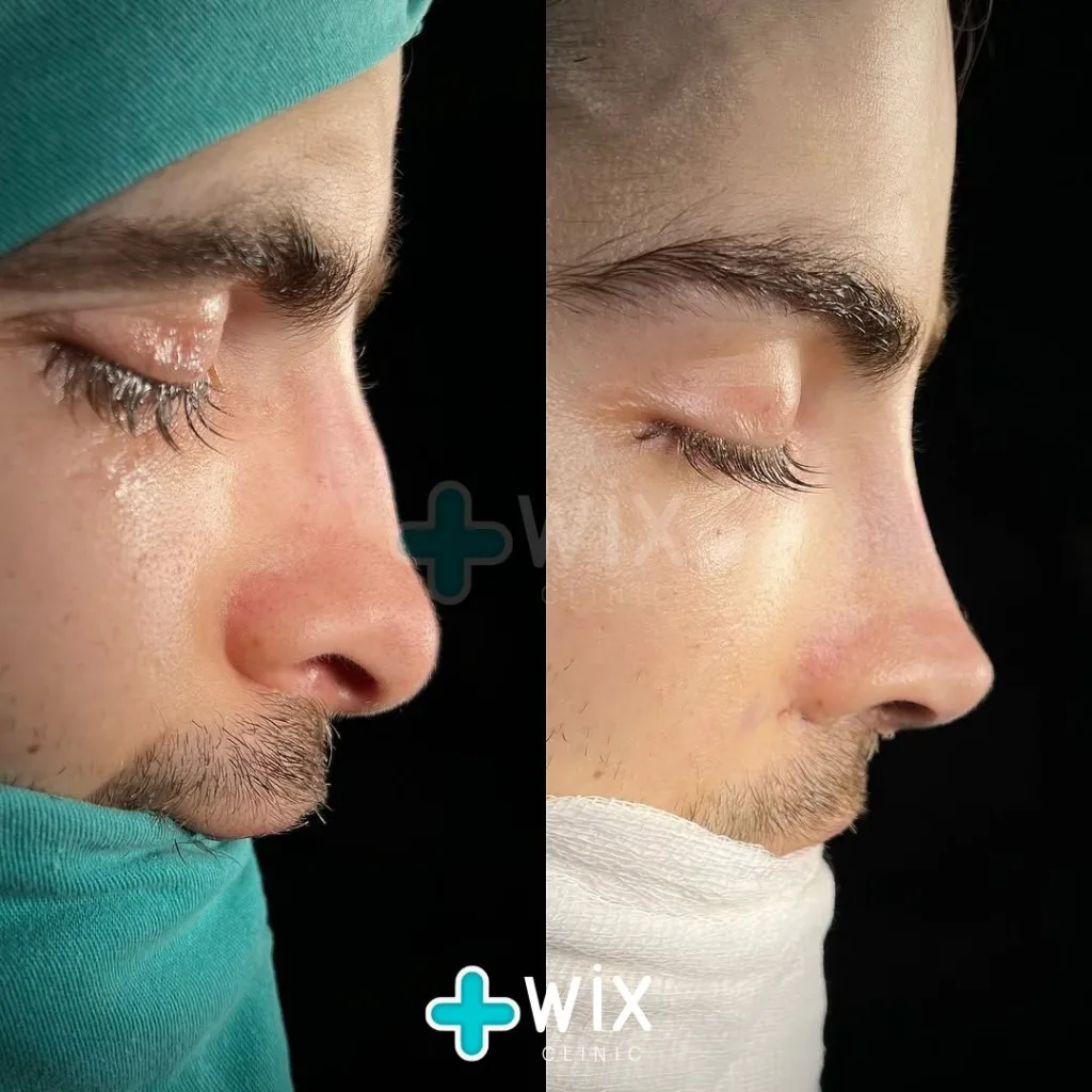 Rhinoplasty Before and After