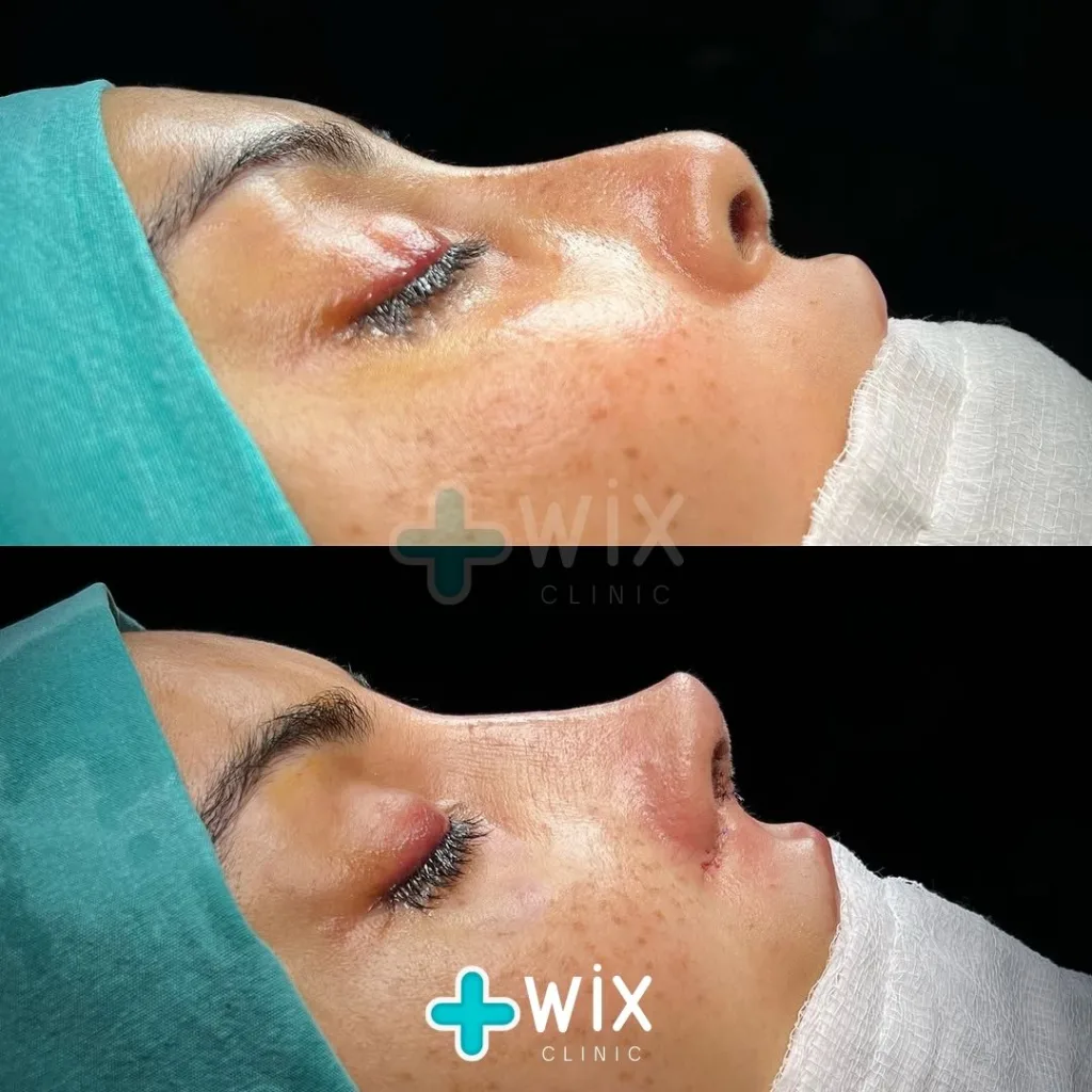 Rhinoplasty Before and After