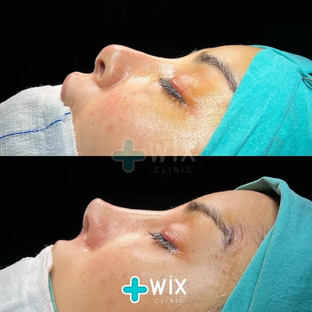 Rhinoplasty Before and After