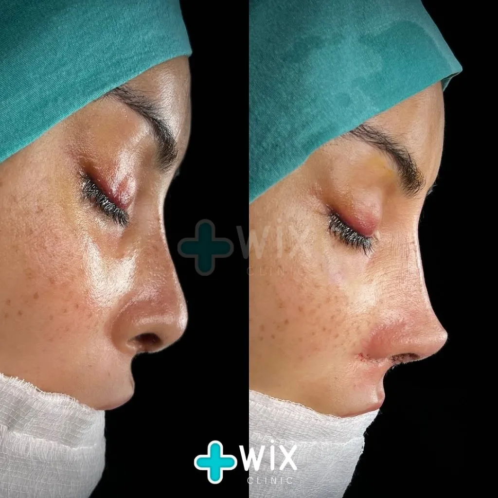 Rhinoplasty Before and After