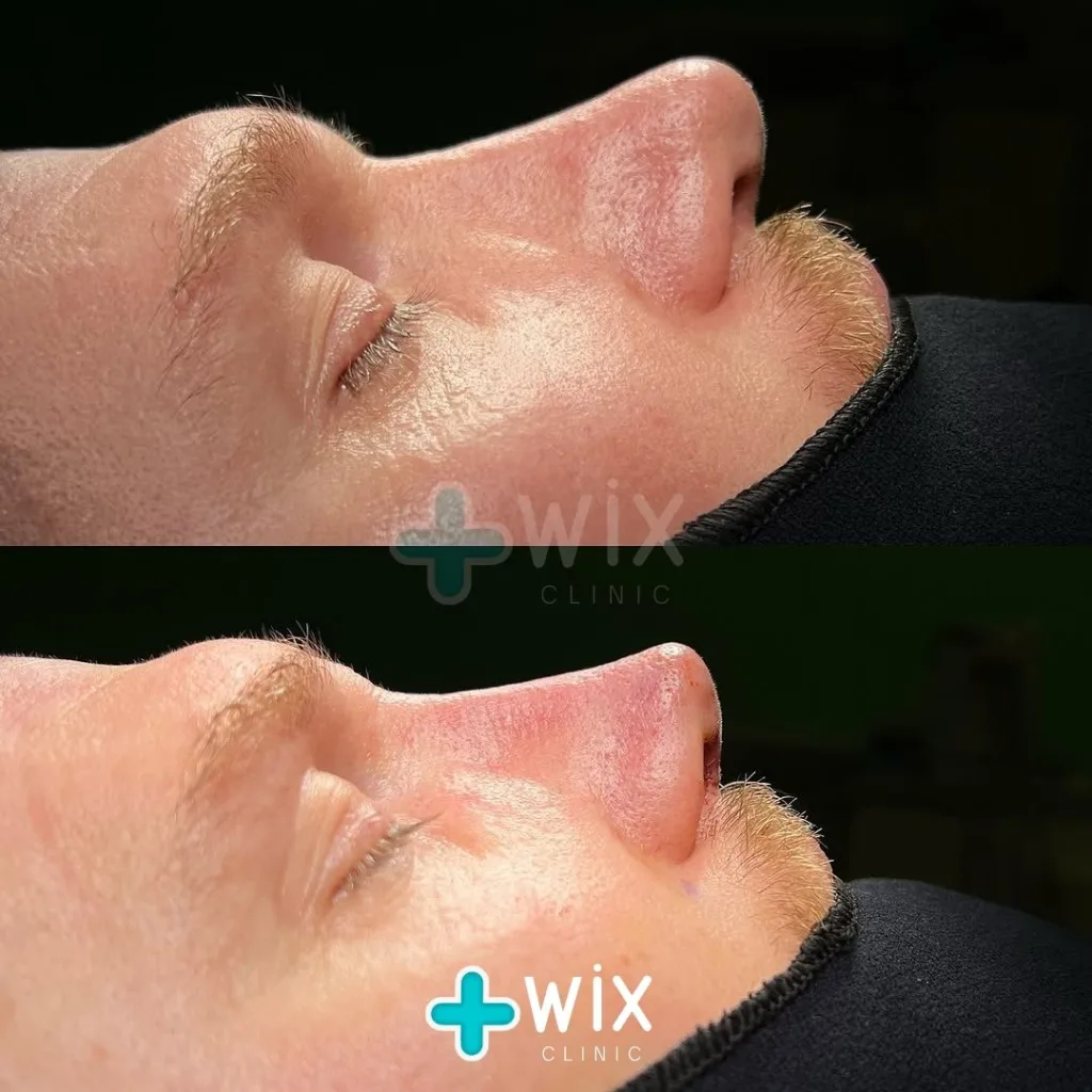 Rhinoplasty Before and After