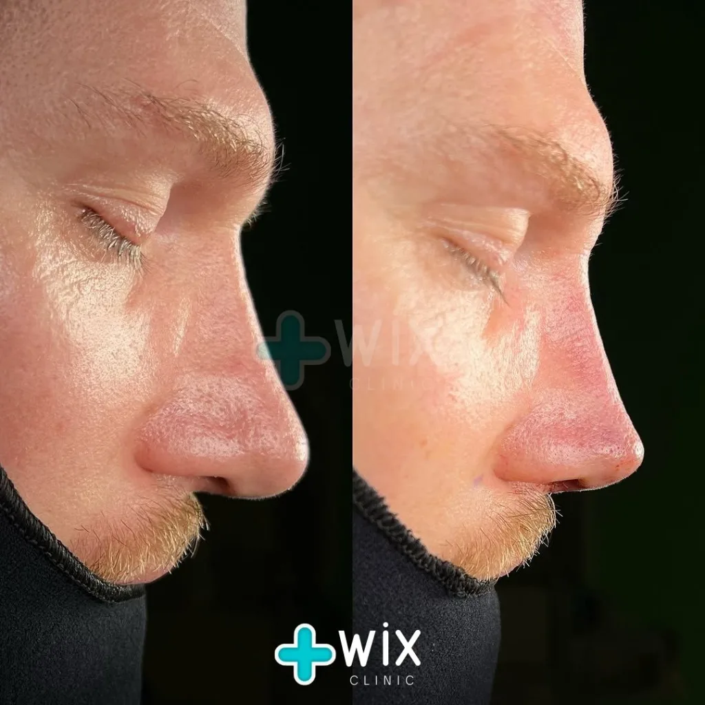 Rhinoplasty Before and After