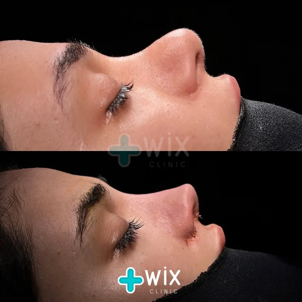 Rhinoplasty Before and After