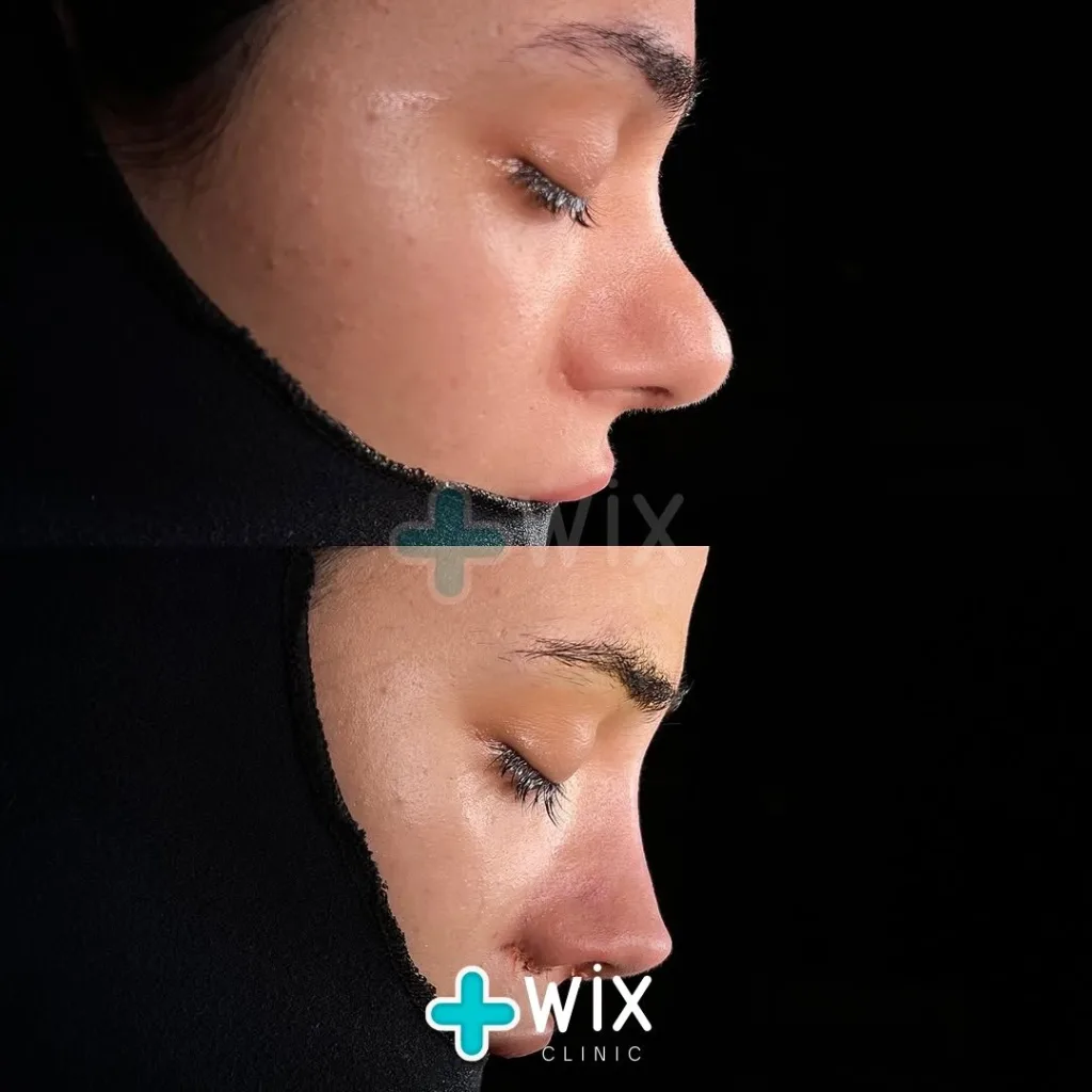 Rhinoplasty Before and After