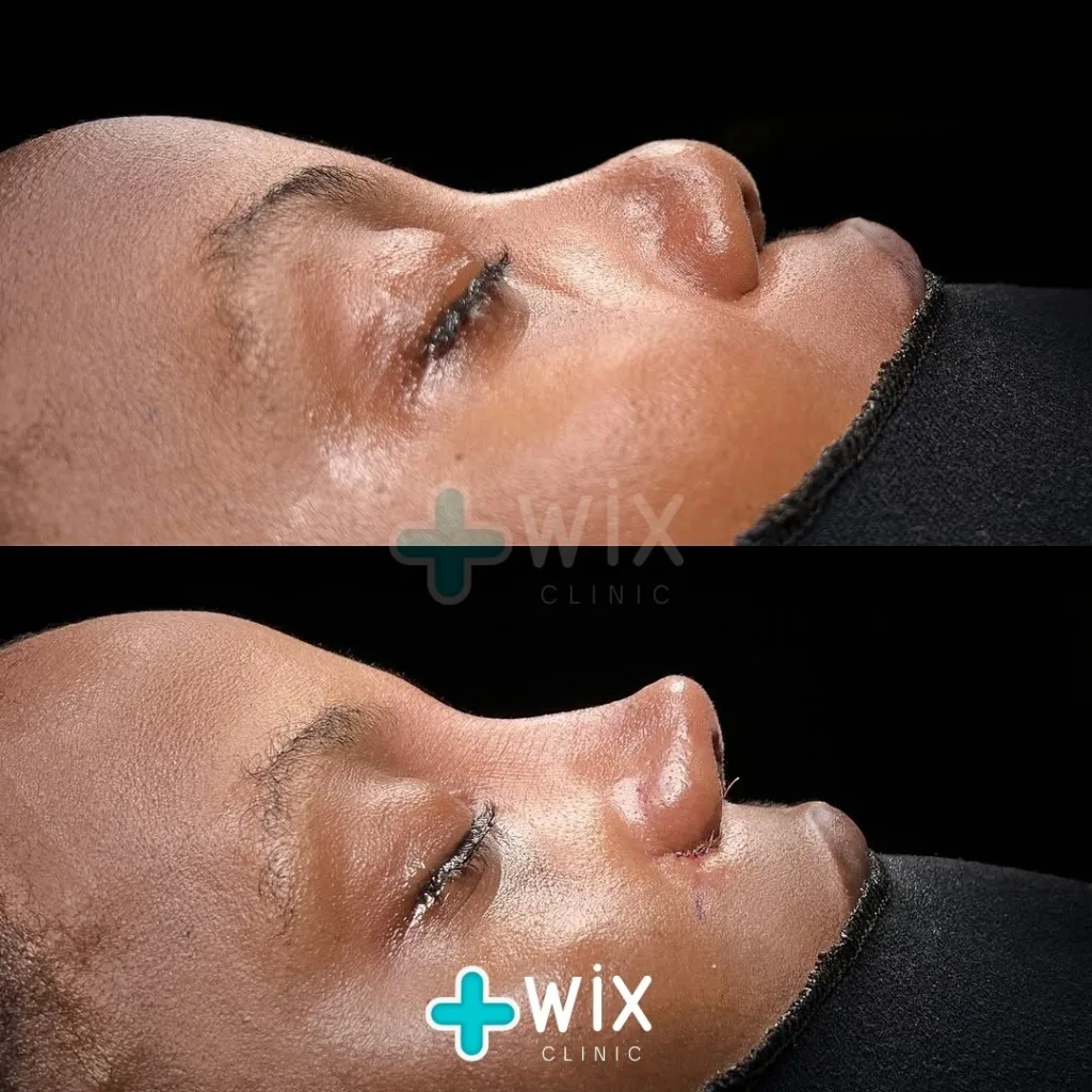 Rhinoplasty Before and After