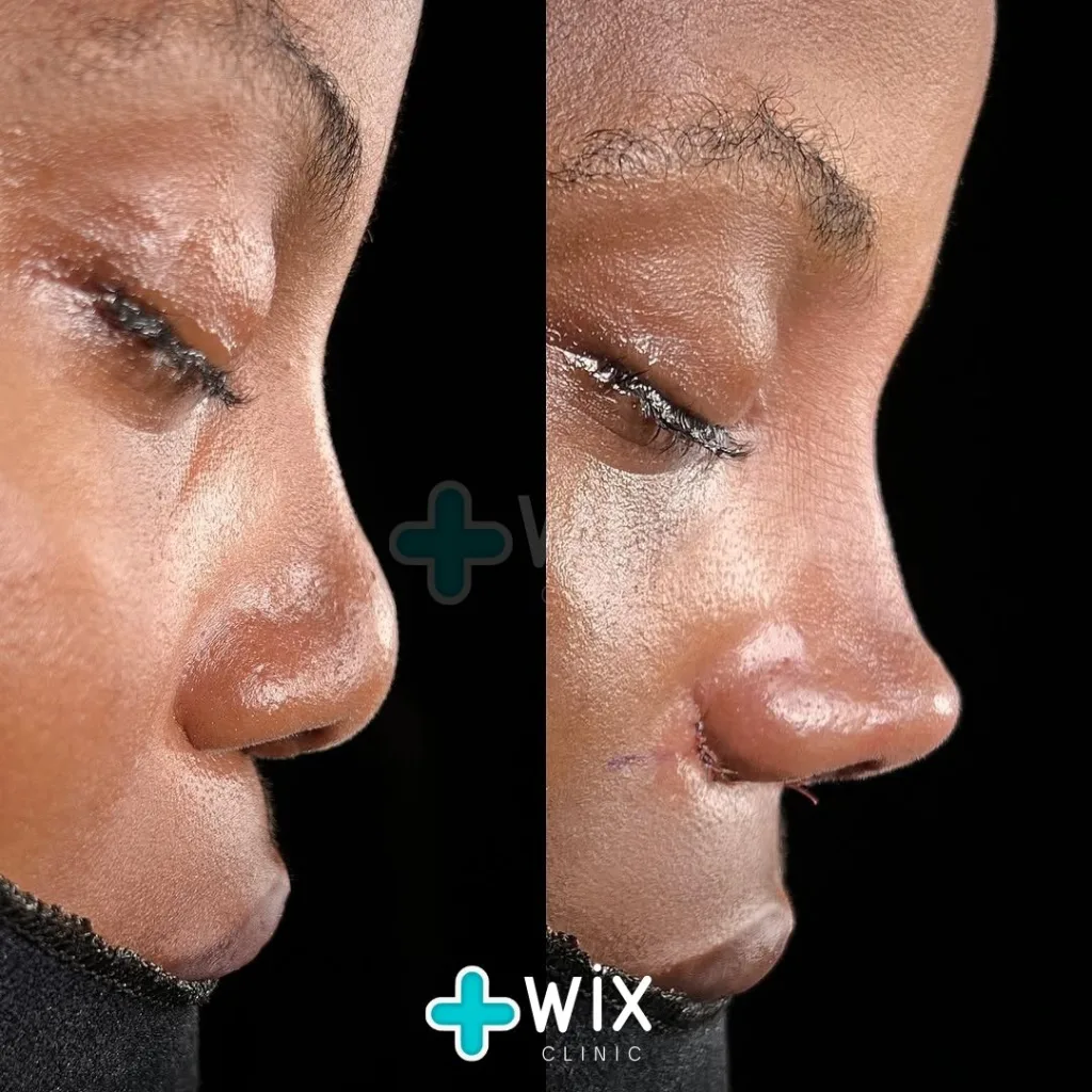 Rhinoplasty Before and After