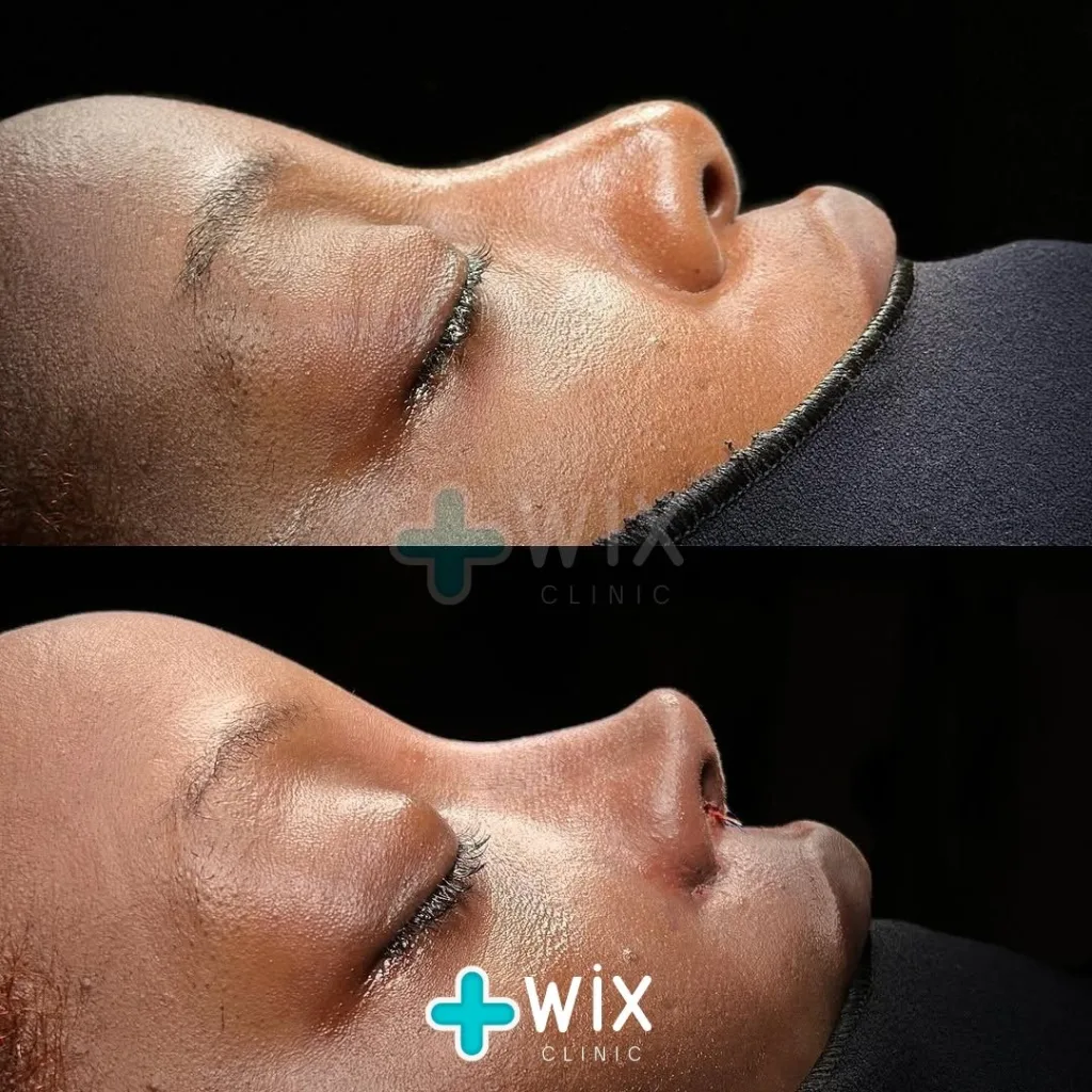 Rhinoplasty Before and After