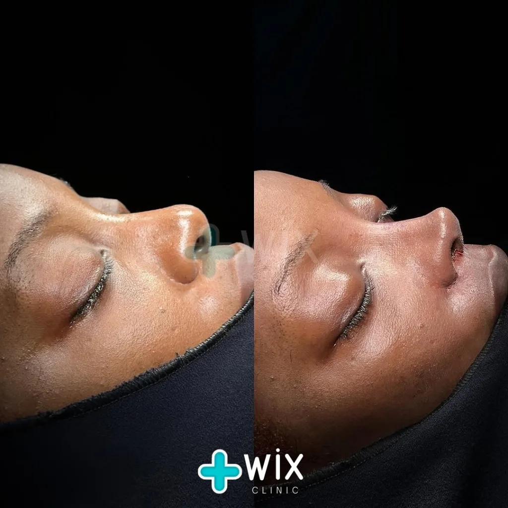 Rhinoplasty Before and After