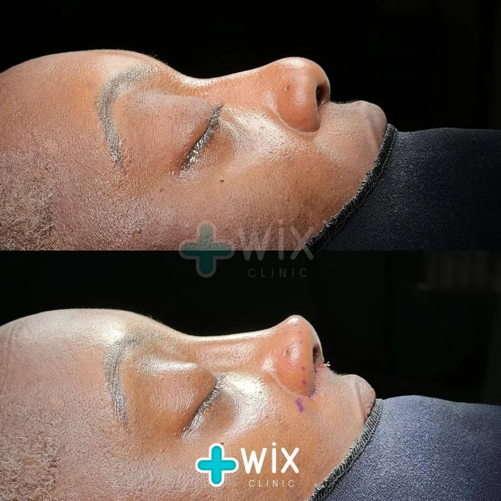 Rhinoplasty Before and After